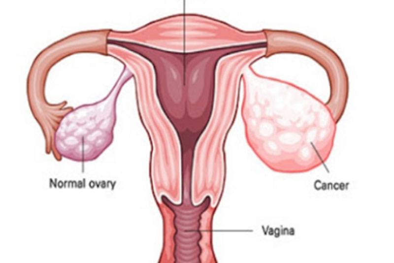 पछिल्लो समय महिलामा पाठेघरसम्बन्धी रोग बढ्दो